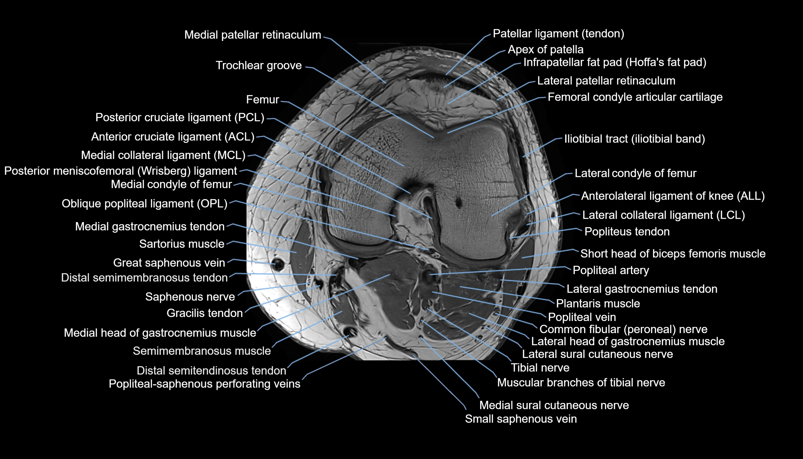 MRI knee  axial cross sectional anatomy 3T radiology  image-img-00001-00023.webp